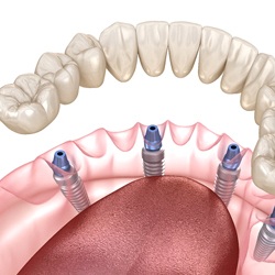 3 D illustration of implant dentures