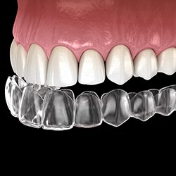 A digital image of an Invisalign aligner preparing to go on the top row of teeth
